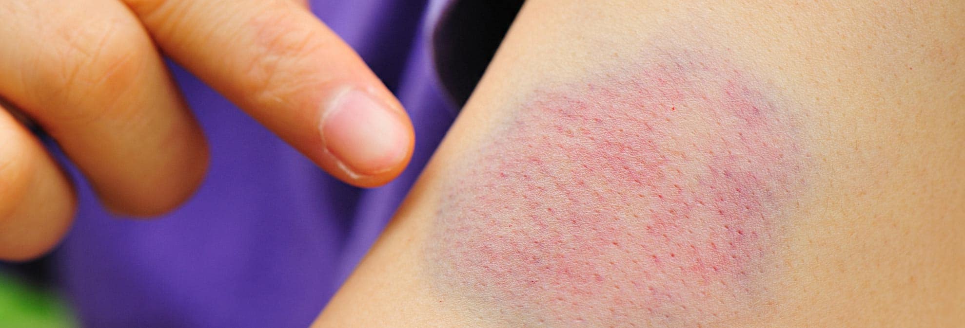 What It Means If You Bruise Easily Consumer Reports